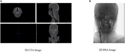 Enhancing the depth perception of DSA images with 2D–3D registration